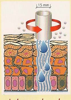 dermabrasion karlsruhe